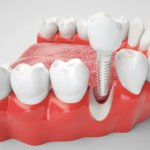 Dental Implant