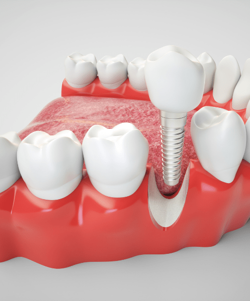 Dental Implant